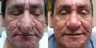 25-34 year old man treated with CO2 Laser - Severe Rhinophyma treated with J-Plasma skin resurfacer 3months before and after