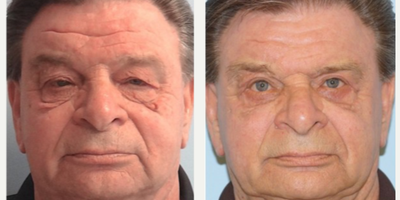 65-74 year old man treated with Ptosis Surgery - Upper blepharoplasty with levator advancement to re-suspend the eyelid is performed in-office with minimal discomfort. Post-op photos show enhancement of both vision and appearance (more energetic look) evident on frontal view as the light reflex is now seen on the pupil (Right photo).