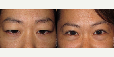 35-44 year old woman treated with Asian Eyelid Surgery - Woman with ptosis and dermatochalasis preoperatively