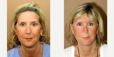 Woman treated with Facelift - Woman treated with Facelift
