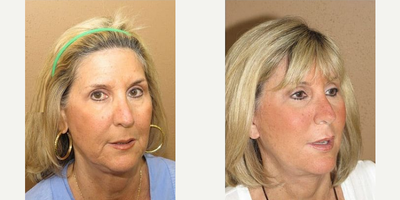 Woman treated with Facelift - Woman treated with Facelift