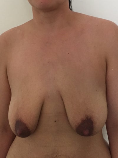 music to have sex to augmentation breast lift photo