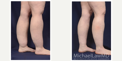 35-44 year old woman treated with Calf Reduction - Lower leg liposuction. Follow-up photo taken 6 months after the procedure.
