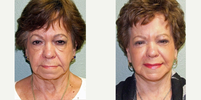 75 and up year old woman treated with Quick Lift - 78 year old woman who underwent facial surgery including Quicklift, Lateral Browlift, and Upper/Lower Eyelid surgery.