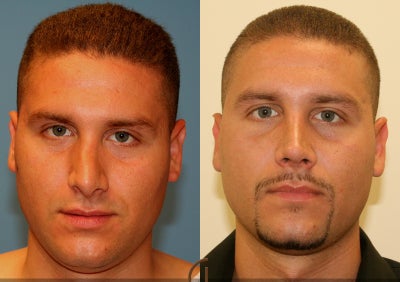 Revision Rhinoplasty - This patient had previous rhinoplasty by another surgeon and was not happy with the shape of his nose. Dr. Sadati performed a revision rhinoplasty on him.