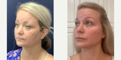 45-54 year old woman treated with Breast Fat Transfer - 45-54 year old woman treated with Facial Fat Transfer