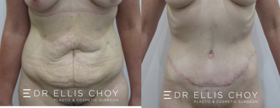 25-34 year old woman treated with Tummy Tuck - Full Tummy Tuck post weight loss