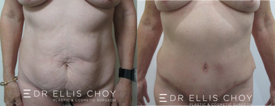 55-64 year old woman treated with Tummy Tuck - Combined Breast Lift and Full Tummy Tuck post massive weight loss