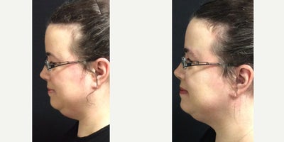 35-44 year old woman treated with CoolMini - 2 CoolMini on the chin.