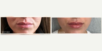 25-34 year old woman treated with Lip Fillers - Lip filler