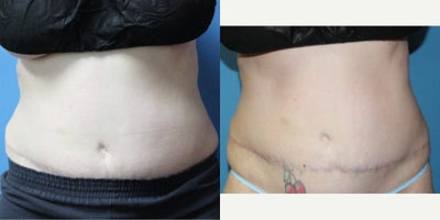 35-44 year old woman treated with CoolSculpting - This patient was treated with the upgraded CoolSculpting Elite machine. The upgraded technology offers great results with minimal discomfort.
