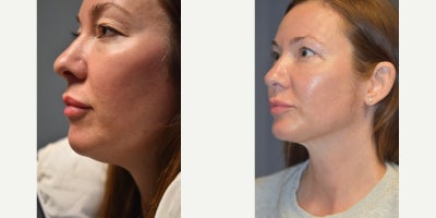 45-54 year old woman treated with Chin Liposuction, CO2 Laser, Double Eyelid Surgery, Eyelid Surgery, Fractional Laser, Laser Re - This woman presented with drooping of the upper eyelids, heavy under eye bags, and fullness in her chin that just bothered her! Dr Woodman listened to her concerns and provided a conservative approach that gave fantastic results. Removing excess skin from the upper eyelids, some of the excess fat that filled out the lower lid (some of us with hollow under eyes WISH we had that fat under there!), and a bit of lipo below the chin were the only incision points, with the only scar left visible being a tiny one under the chin. The laser Blepharoplasty (Upper Eyelid surgery technique we use) scar is hidden within the natural crease, the lower incision is in the lash line- you will never see it!To finish, Dr Woodman gave her an overall CO2 resurfacing refresh, and the results speak for themselves.
