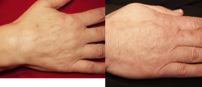 GentleLase - Hands before and after one GentleLase alexandrite laser treatment for brown spots