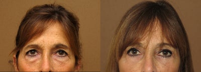 Eyelid lift procedure combined with endobrow - endoscopic brow lift -
Combination of upper and lower eyelid correction (blepharoplasty) with lower eyelid fat transfer and endoscopic brow lift to correct upper face aging