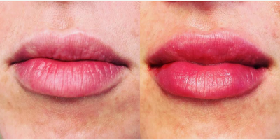 35-44 year old woman treated with Lip Fillers - This 35-year-old patient was looking for a fuller yet natural lip.
