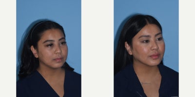 25-34 year old woman treated with Buccal Fat Removal, Chin Implant - My nurse loves the more sculpted appearance of her face. #chinimplant #neckliposuction #buccalfatremoval A rounder face is transformed in a beautifully subtle manner. The jawline looks chiseled with a slightly extended chin. Her cheek appears elevated and highlighted from the removal of #buccalfat. All in a natural way.