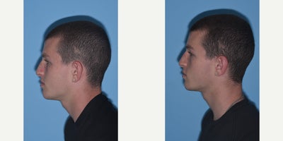 17 or under year old man treated with Ear Surgery - Otoplasty Surgery.