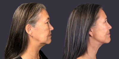 55-64 year old woman treated with Chemical Peel, Eyelid Surgery, Facelift, Lower Facelift, Neck Lift, TCA Peel, Velashape - 63 year old woman who is 5'3 tall and weighs 153 pounds. She had an upper eyelid lift, TCA chemical peel around the eyes, and a lower face and neck lift. Her after photos are at 6 months.