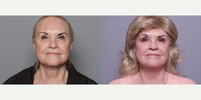 55-64 year old woman treated with Mini Lift - 55-64 year old woman treated with Mini Lift