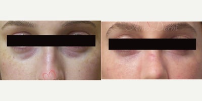 25-34 year old woman treated with Juvederm, Volbella, Voluma, Restylane, Restylane Contour - 4D Under Eye Lift - Treatment of dark circles & bags under eyes and cheek restoration with Belotero, Restylane, Volbella and Voluma