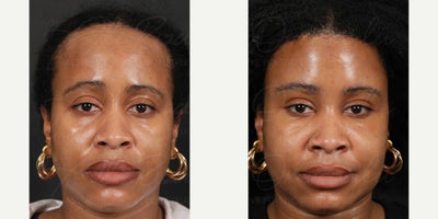 35-44 year old woman treated with Forehead Reduction - A middle-aged female patient underwent forehead reduction. The images show her natural-looking results at 3 months postoperatively, with improved facial balance and rejuvenation.