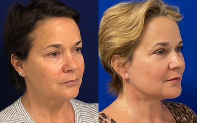 55 year old woman treated with Facelift - 55 year old 1 month and 5 months post facelift, necklift, upper blepharoplasty, lower eyelid skin pinch, fat transfer, and full face co2 laser.