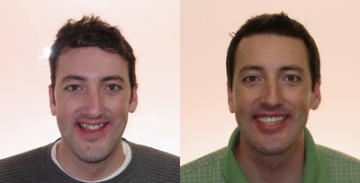 Severe Underbite Treated with Braces and Orthognathic Surgery - He was a severe Class III (underbite or anterior crossbite) with maxillary constriction (posterior crossbite). The timetable when patient's need jaw surgery is typically like this. I place braces first to get general alignment for 9-12 months. I then send them to the oral surgeon for the surgery. He usually stays 1-2 days in the hospital to rest. In this case, upper and lower jaw surgery was required. We allow him to heal for about 6 weeks i.e. no adjustments on his braces. I then finish his orthodontic work over the next 6-12 months depending on severity of case.