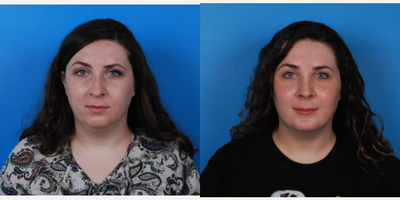 25-34 year old woman treated with Rhinoplasty - 25-34 year old woman treated with Rhinoplasty