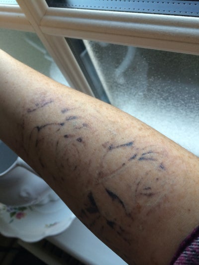 LARGE ROSE TATTOO REGRET - PicoSure review - RealSelf