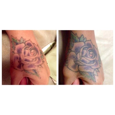 getting the rose tattoo on my hand removed newport news getting the rose tattoo on my hand removed newport news