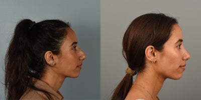 25-34 year old woman treated with Rhinoplasty - 28 year old interested in smoothing dorsal hump and refining the nasal tip.