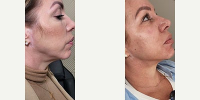 45-54 year old man treated with Radiesse - Neck Rejuvenation combining PDO threads and Radiesse Collection