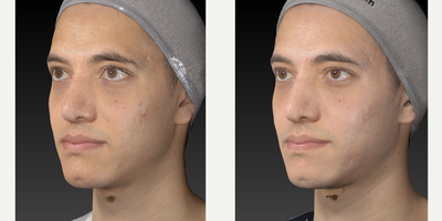 25-34 year old man treated with Microneedling, Skin Lightening, Skin Rejuvenation, Scar Removal - Microneedlin with our special device Nanopore Stylus 02This devices delivers a speed of 200 RPM and combined with a special cocktail of growth factors and liposomated BHA and AHAImpoves skin quality and overall texture, including scarsTotal of 4 sessions done on this patient Combined with a skincare regimen optimized for his needs