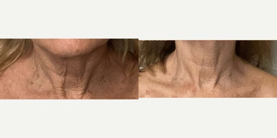 55-64 year old woman treated with Skin Rejuvenation, Laser Resurfacing - Patient was concerned with sun-damaged crepey skin on neck along with deep lining ,uneven texture and excess pigmentation. Her results are less discoloration, smoother texture and even appearance.
