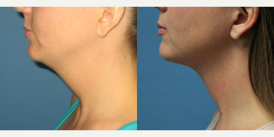 18-24 year old woman treated with PrecisionTx - Liposuction - Neck / Precision TX Face & Neck