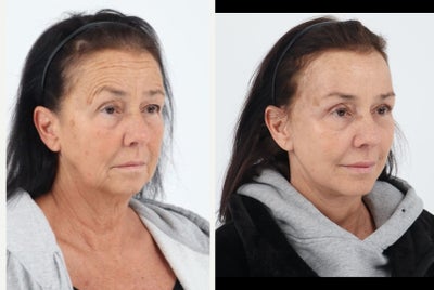 65-74 year old woman treated with Brow Lift, Eyelid Surgery, Facelift, Neck Lift, Facial Fat Transfer, Laser Resurfacing - Patient in her 60's 2month after a Facelift, Neck lift, Facial Fat Transfer, Temporal Brow Lift, Upper Eyelid Blepharoplasty and co2 laser.