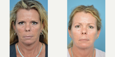 45-54 year old woman treated with Chemical Peel - This 49 year old was looking to address all over sun damage. A Chemical Peel was performed to address her concerns.