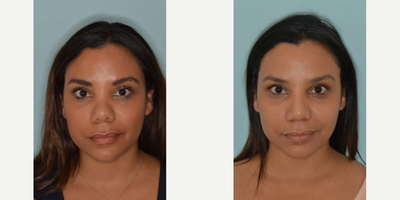 25-34 year old woman treated with Rhinoplasty - Dr. Bared describes his techniques for the refinements in a patient with a very low nasal bridge using her own, natural cartilage and avoiding the use of an artificial implant in the nose.