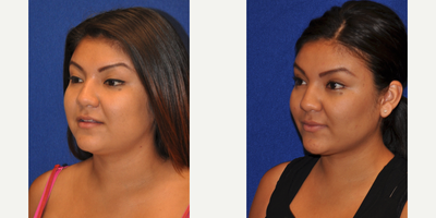 Buccal Fat Removal - Buccal Fat Removal
