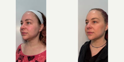 35-44 year old woman treated with Agnes RF - 35-44 year old woman treated with Agnes RF