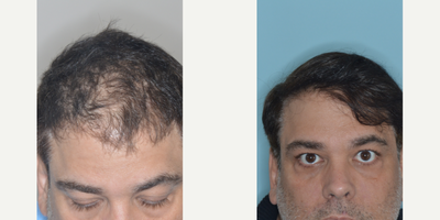 45-54 year old man treated with FUE Hair Transplant - Before and after 1691 FUE hair grafts to help restore density to the frontal area in a male patient with thinning hair