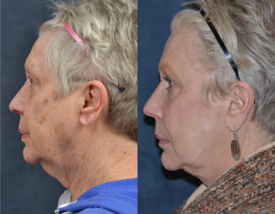 55-64 year old woman treated with Chemical Peel - 35% tca chemical peel for actinic damage and hyperpigmentation