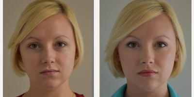 25-34 year old woman treated with Injectable Fillers - New Orleans - Elimination of tired appearance and eyebags using Juvederm Voluma and Juvederm Ultra