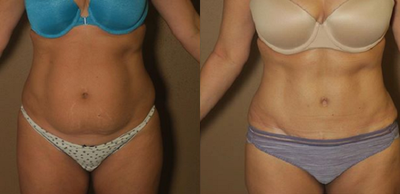 Patient treated with Tummy Tuck - Here we see a woman who had excess skin and unwanted fat in her abdominal area. With a tummy tuck we can contour your abdomen to create a beautiful shape and tighten your muscles
