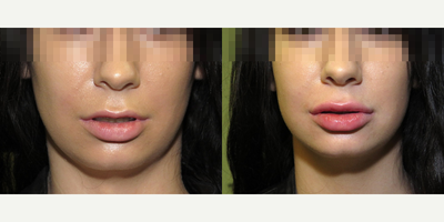 18-24 year old woman treated with Lip Augmentation - Lip augmentation - 20 yo female immediately after lip augmentation with Juvederm