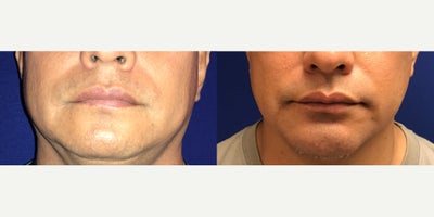 45-54 year old man treated with Chin Implant - Patient is 2 months post op chin implant surgery