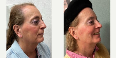 65-74 year old woman treated with Adam's Apple Reduction, Brow Bone Reduction, Brow Lift, Septoplasty, Rhinoplasty, Lip Lift, Ch - This lady underwent facial feminization surgery including forehead feminization, nasal feminization, cheek augmentation, chin feminization and adams apple reduction.