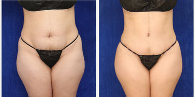 Woman treated with Tummy Tuck - Woman treated with Tummy Tuck