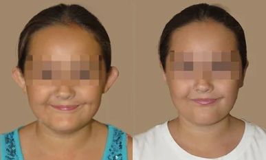 Ear Surgery (Otoplasty) - Ear Pinback on a Young Child - Otoplasty (ear pinback) on a young girl dissatisfied with the appearance of her ears. Procedure was performed under sedation and she back in school in 3 days