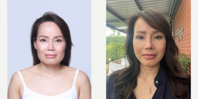 45-54 year old woman treated with Cheekbone Reduction - cheekbone reduction, jaw angle reduction, genioplasty, rhinoplasty revision, facial liposuction, face lift, under eye bag reposition surgery